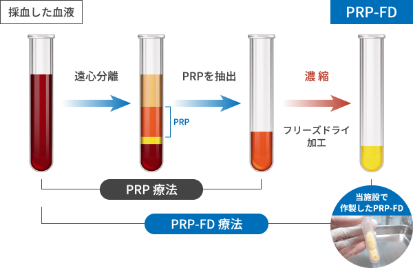 PRP-FD療法とPRP療法の違い