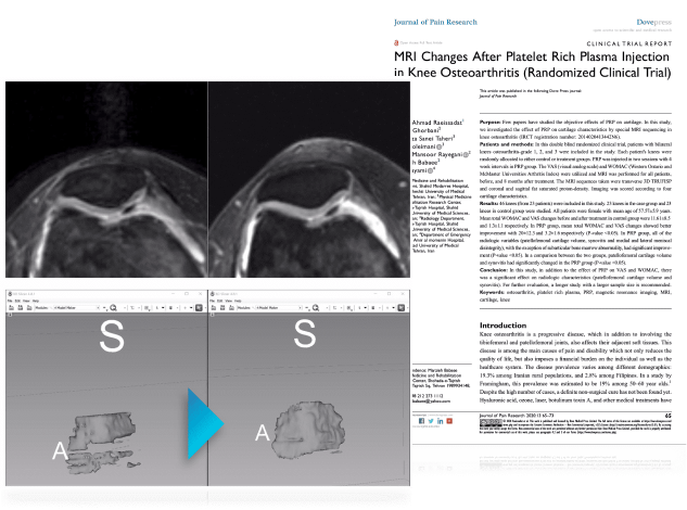 MRI Changes After Platelet Rich Plasma Injection in Knee Osteoarthritis