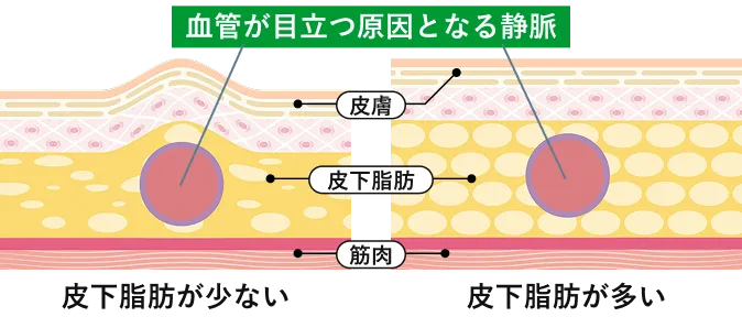 加齢による皮膚の薄化