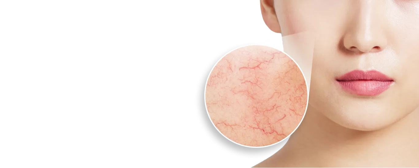 顔に浮き出た血管が気になる方へ フェイススクレロセラピー 顔の血管をピンポイントで消す