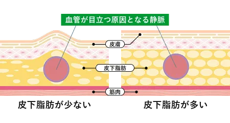 加齢による皮膚の薄化
