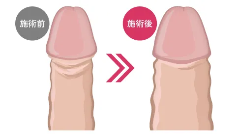 メンズ増大PRPG注射の施術前後