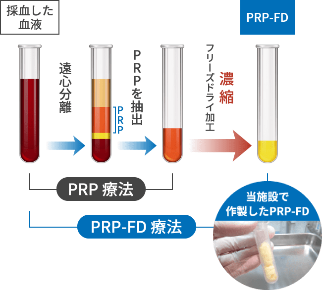 PRP-FD(PFC-FD)療法とPRP療法の違い