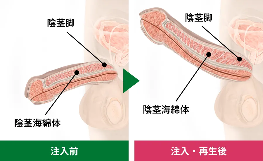 勃起時の陰茎伸長効果