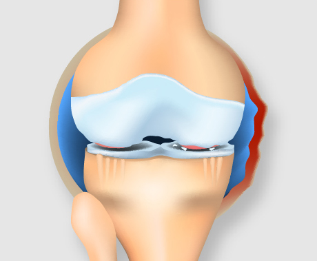 中期のひざ関節