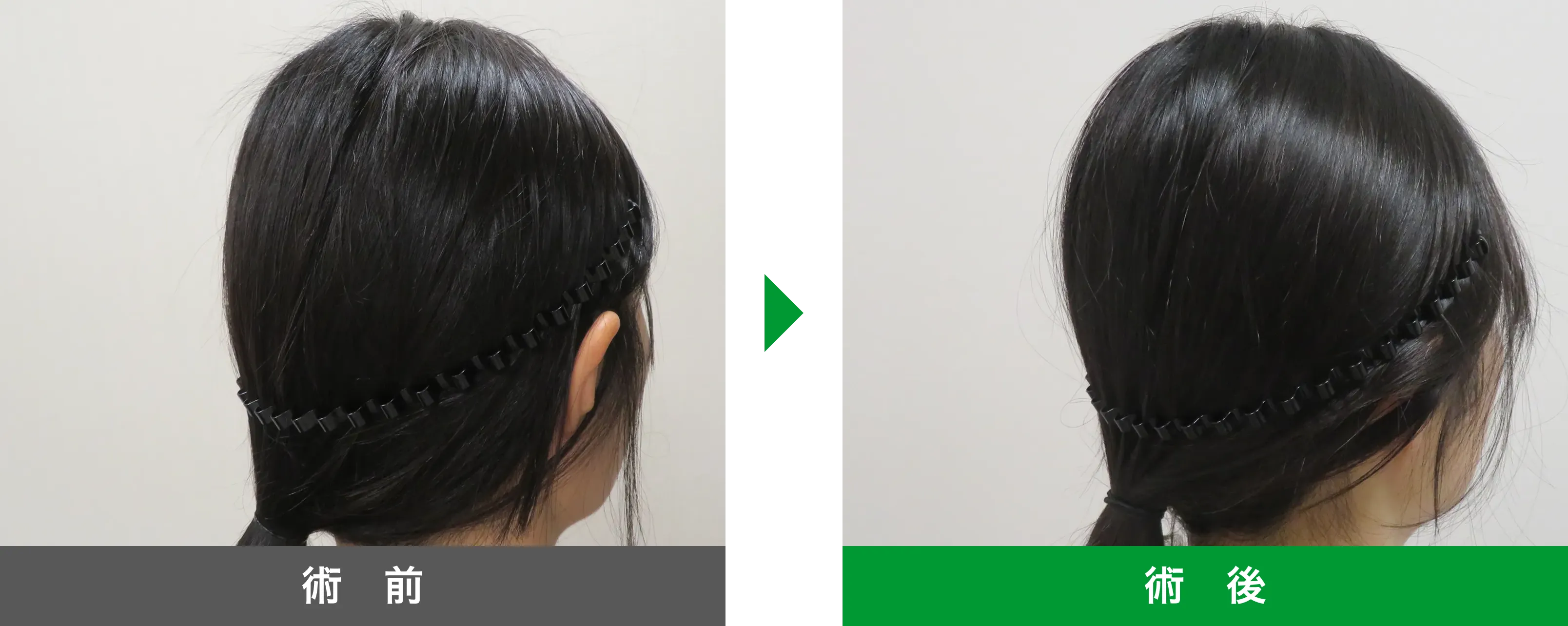 後頭部形成術 症例写真 術後