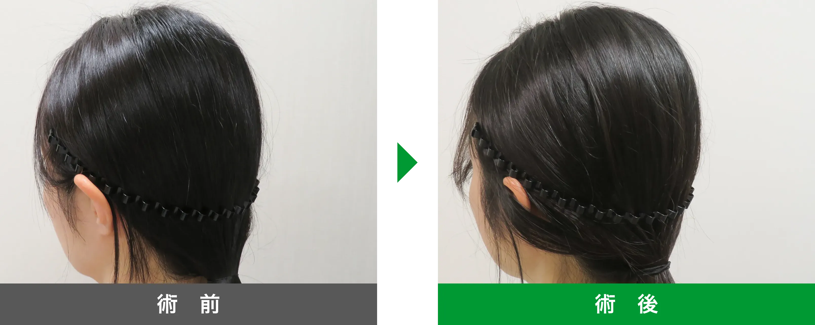 後頭部形成術 症例写真 術後