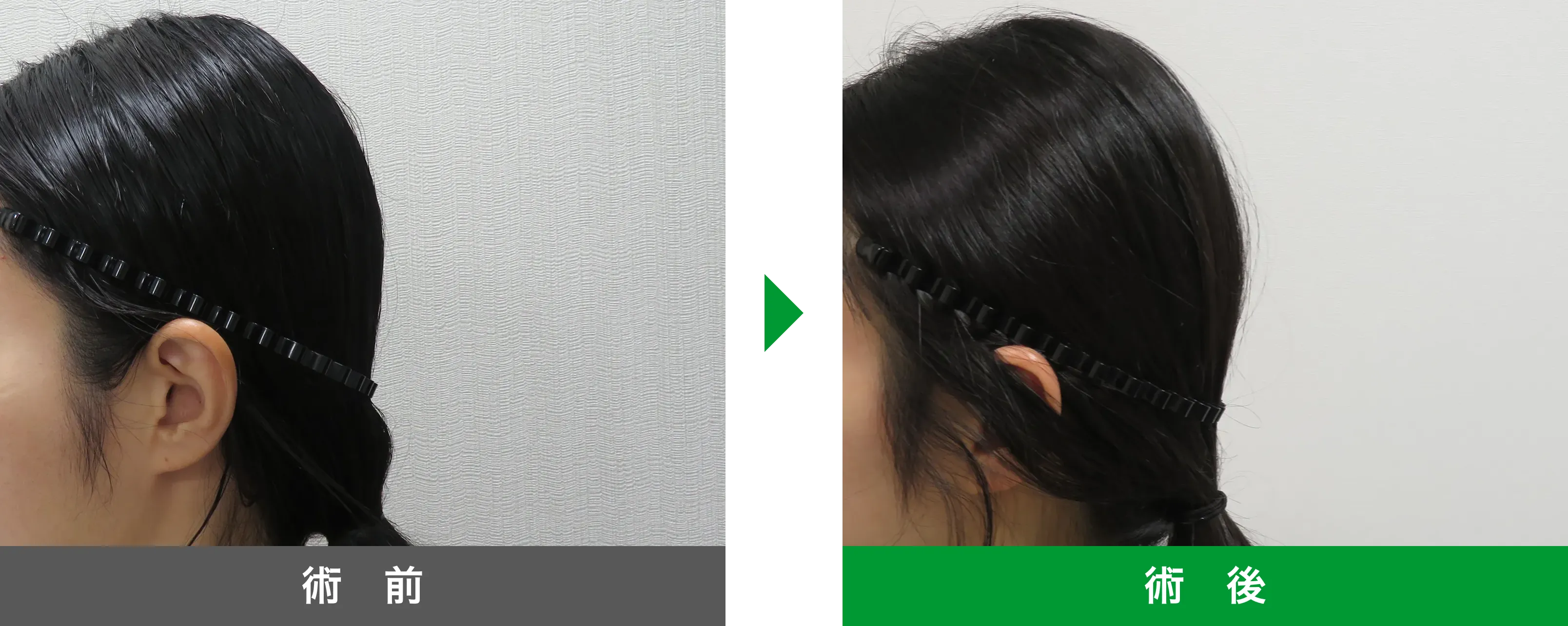 後頭部形成術 症例写真 術後