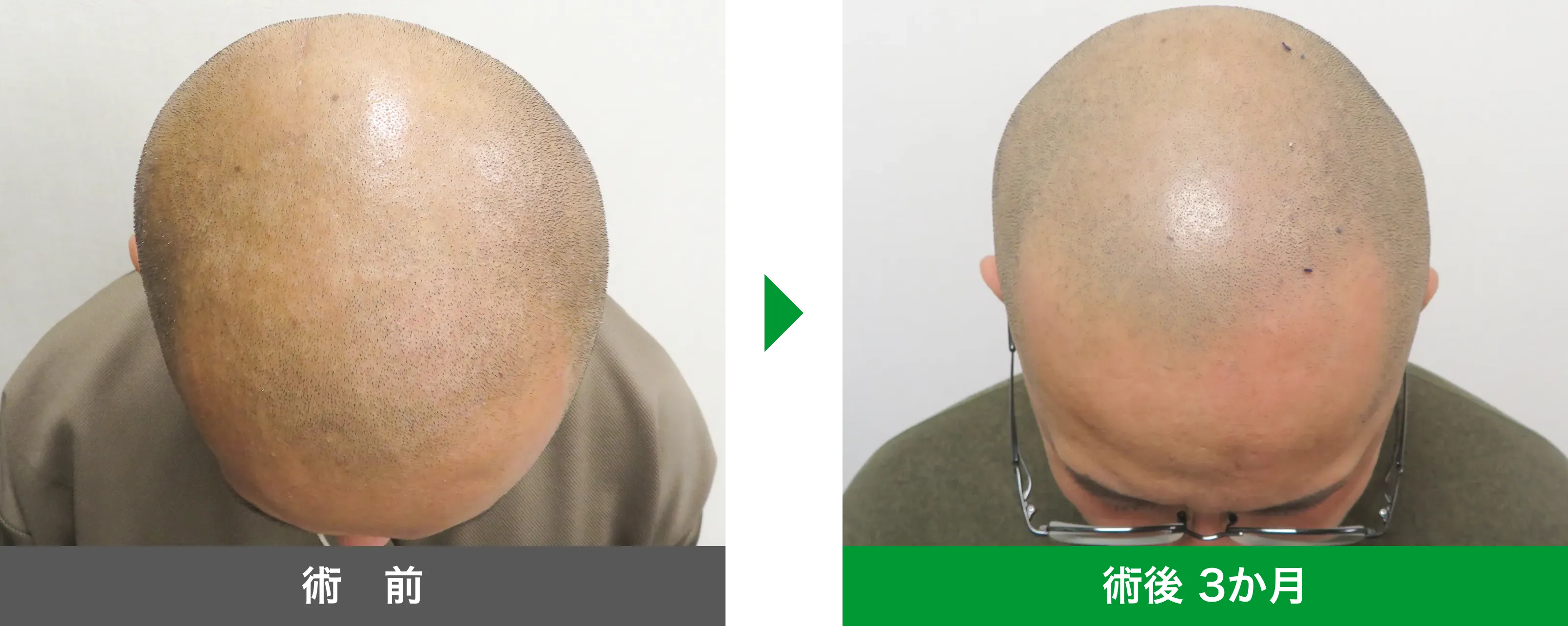 後頭部形成術 症例写真 術後 3か月