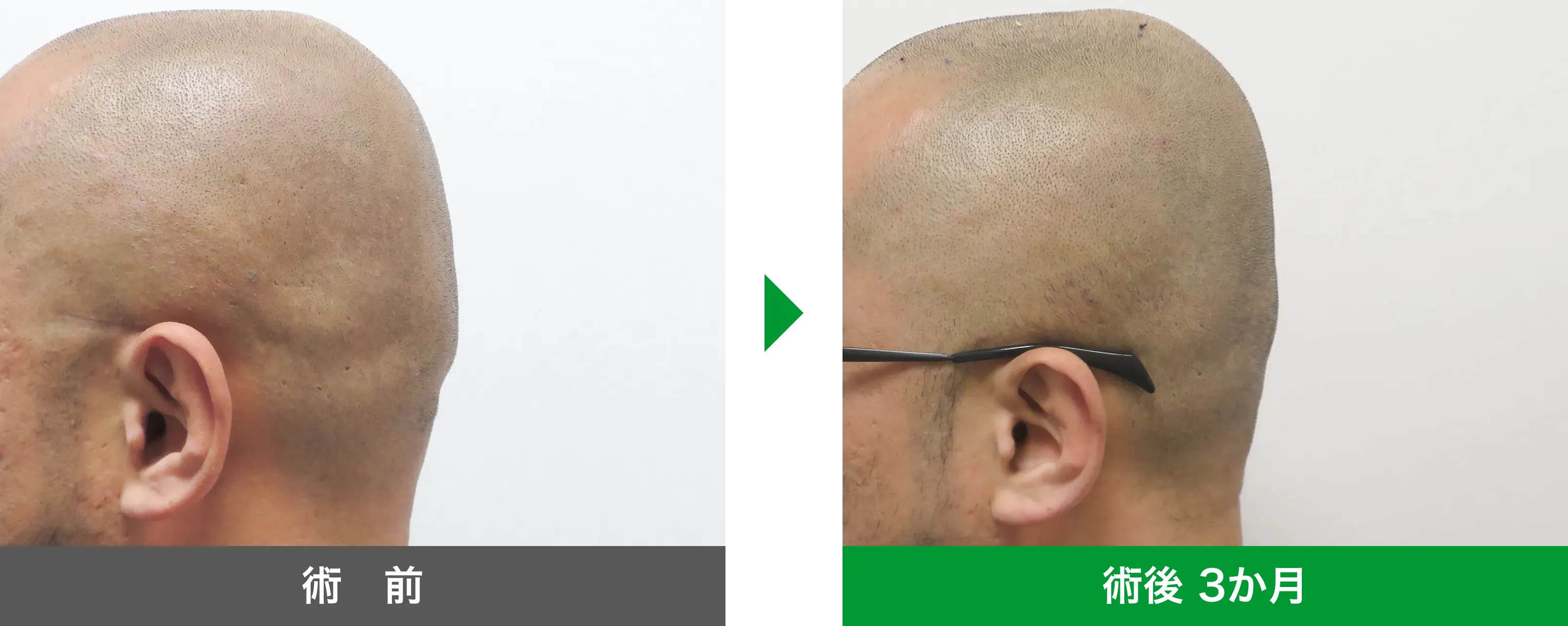 後頭部形成術 症例写真 術後 3か月