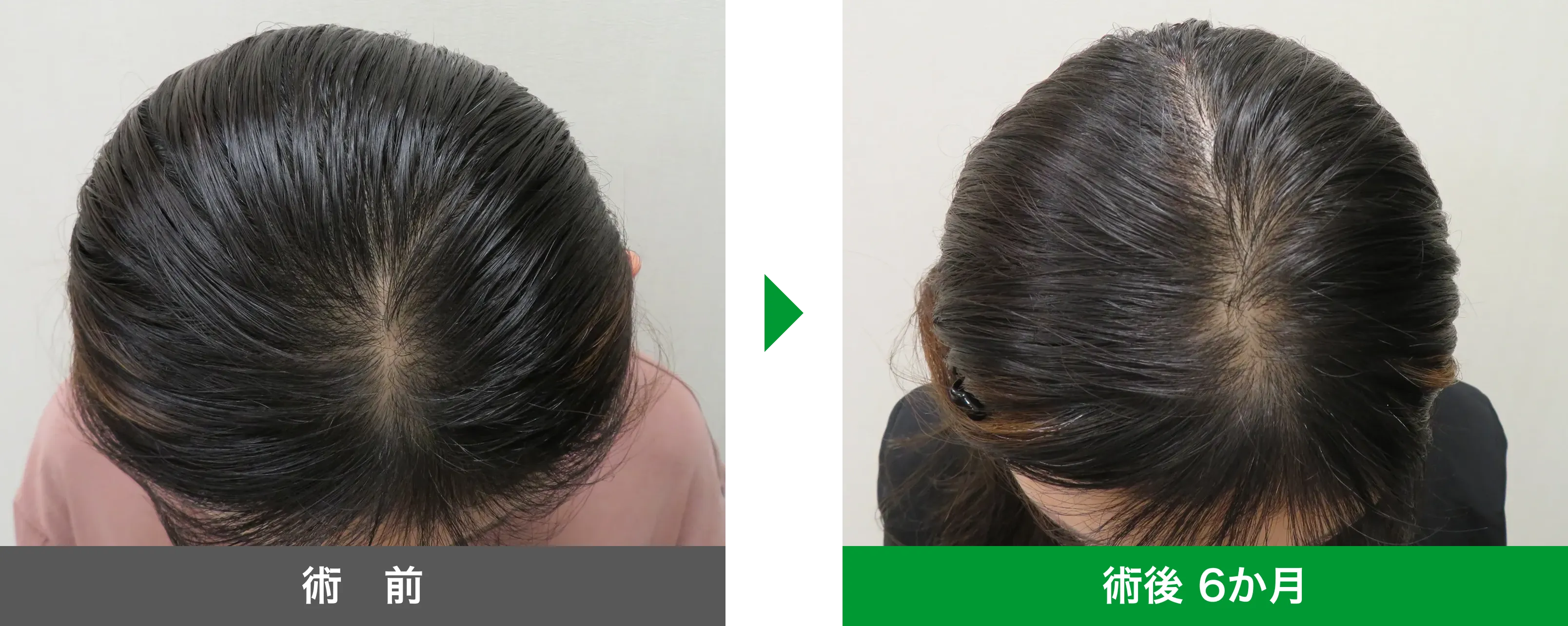 後頭部形成術 症例写真 術後 6か月