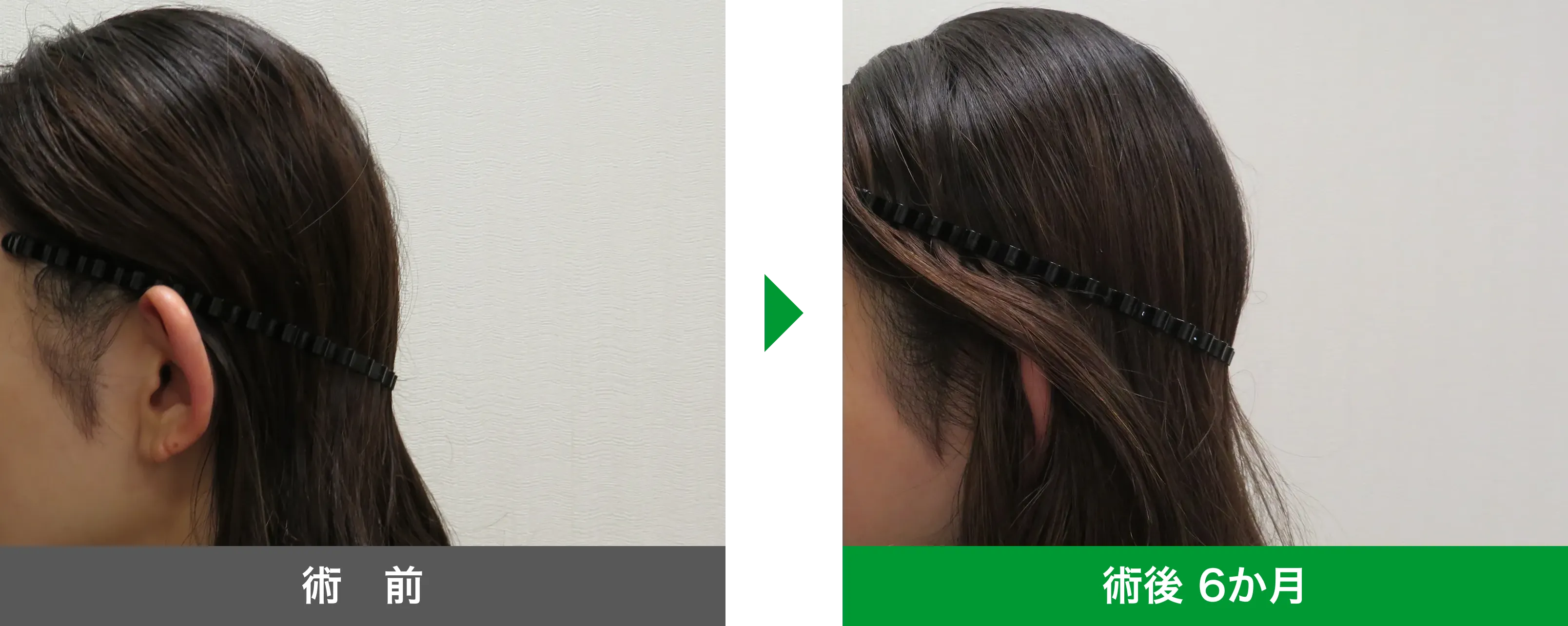 後頭部形成術 症例写真 術後 6か月