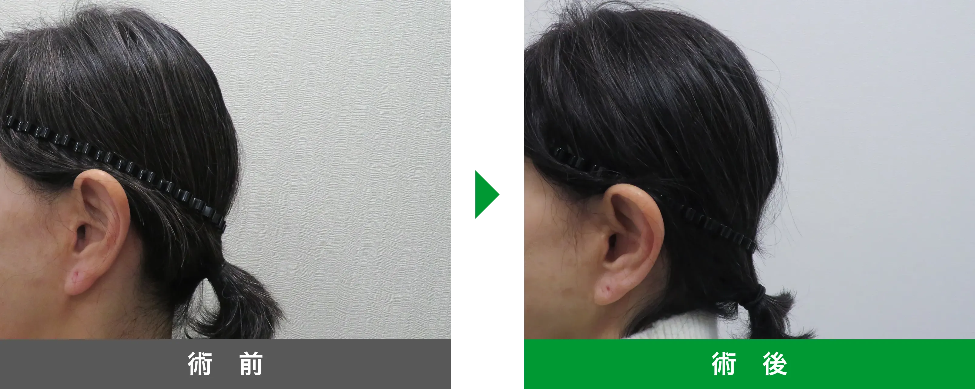 後頭部形成術 症例写真 術後