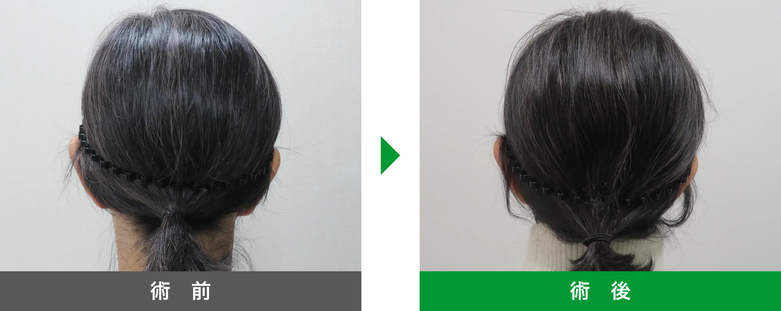 後頭部形成術 症例写真 術後