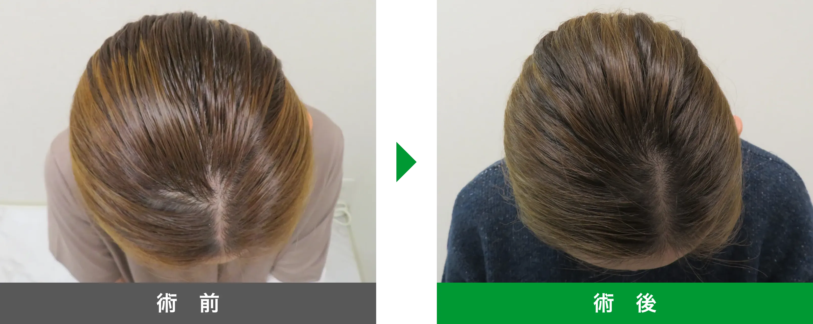 後頭部形成術 症例写真 術後