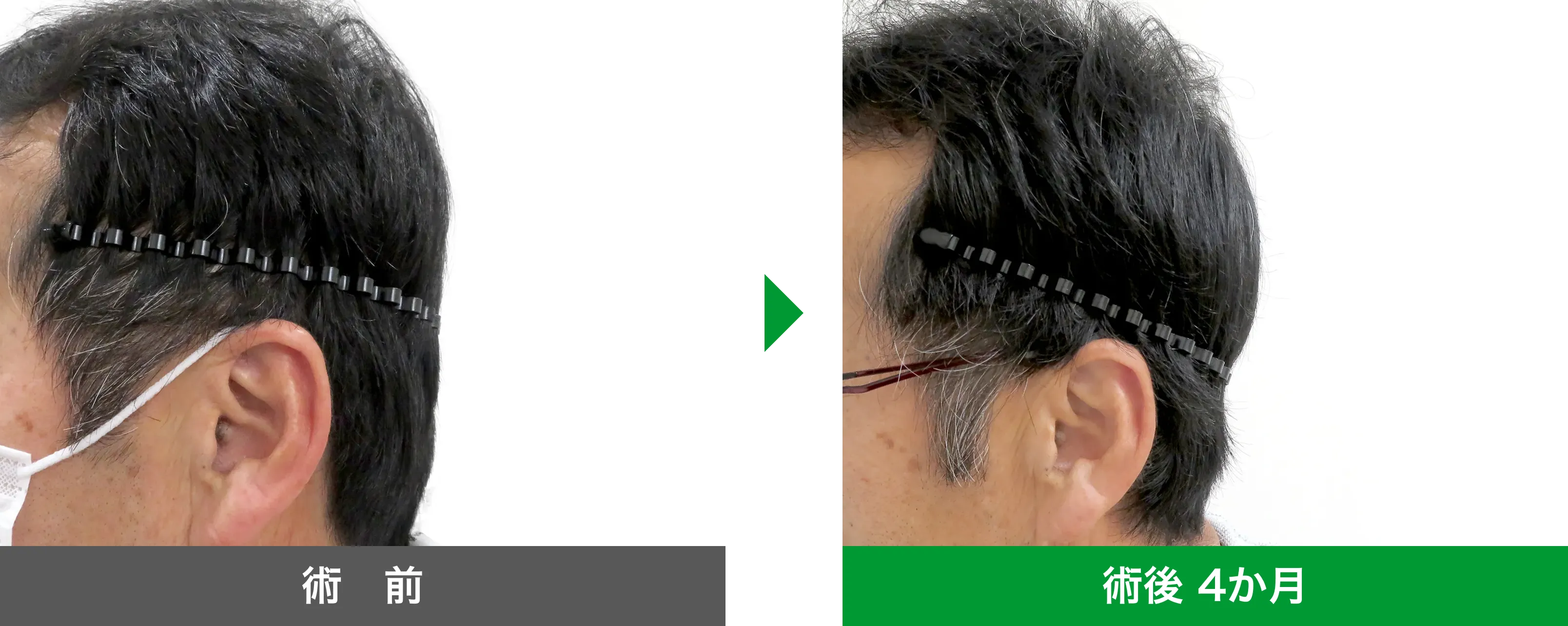 後頭部形成術 症例写真 術後 4か月