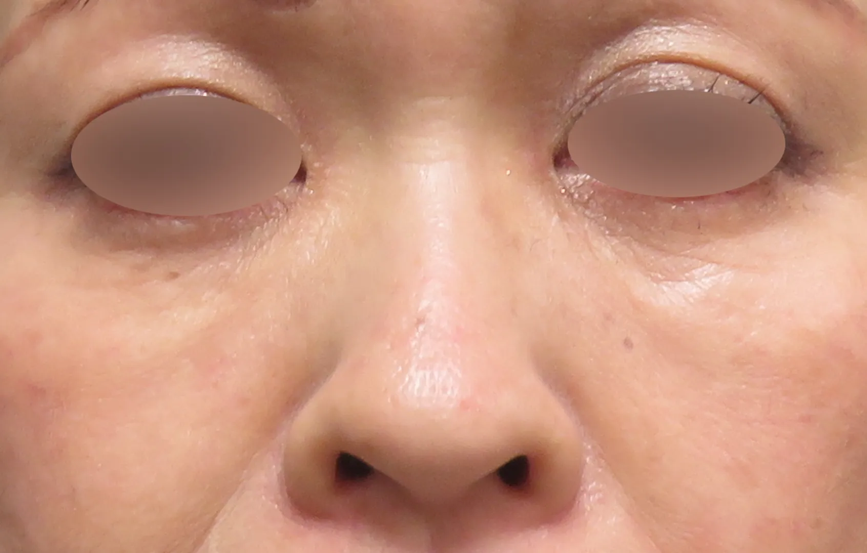 伏見ウェルネスクリニック PRPG修正注射 目の下 症例（術後）