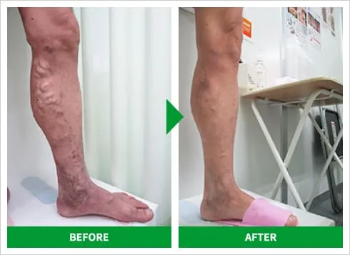 下肢静脈瘤の高周波治療 症例1 施術前後の比較写真