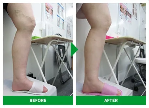 下肢静脈瘤の高周波治療 症例3 施術前後の比較写真