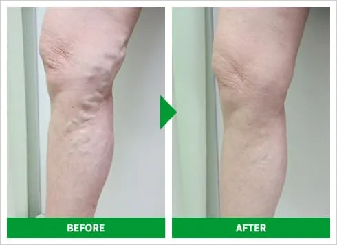 下肢静脈瘤の高周波治療 症例4 施術前後の比較写真
