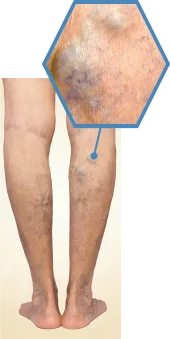 Stage3 伏在型静脈瘤の症例写真