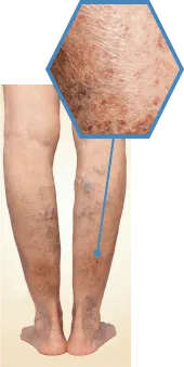 Stage4 色素沈着の症例写真