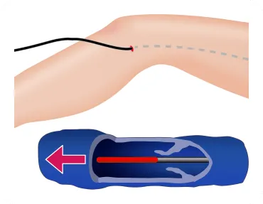カテーテルを用いた下肢静脈瘤の血管内治療イメージ