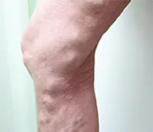 大伏在静脈瘤の発症部位を示すイラスト