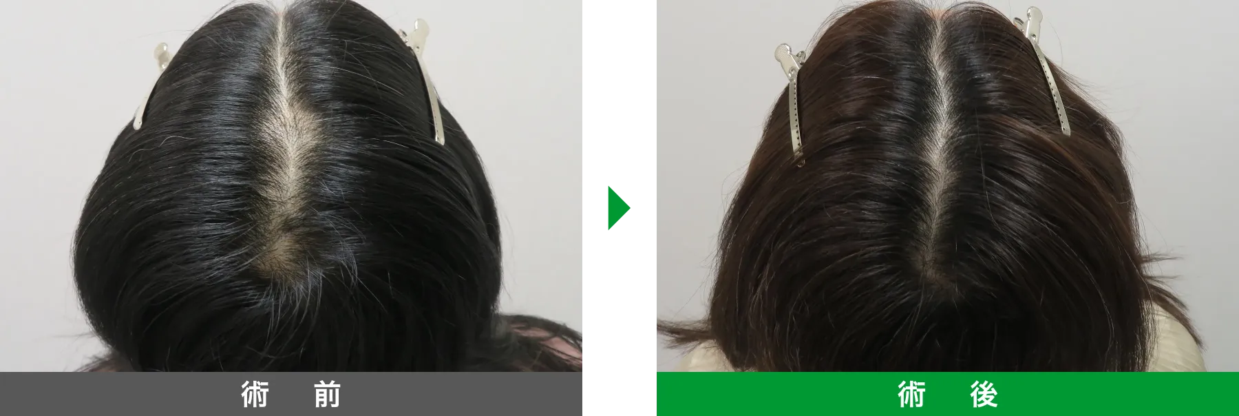 w-スカルプ 症例写真 術後