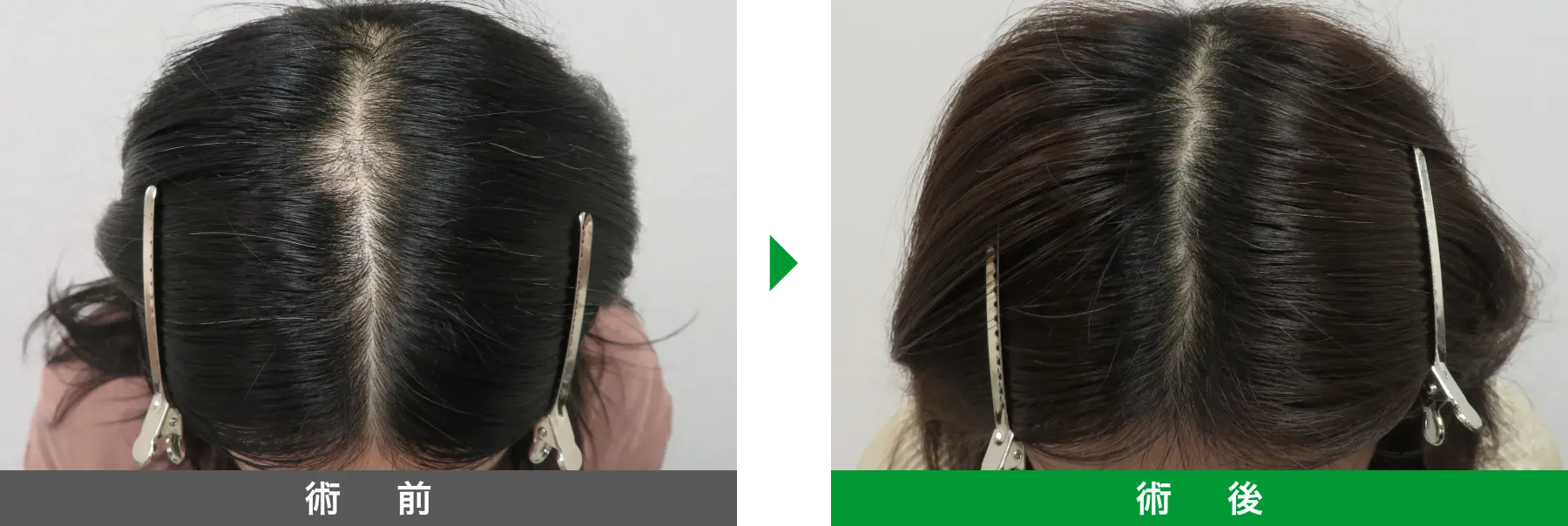 w-スカルプ 症例写真 術後