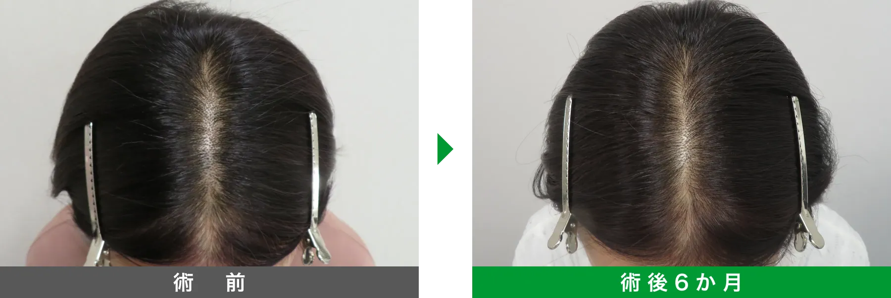 w-スカルプ 症例写真 術後 6か月