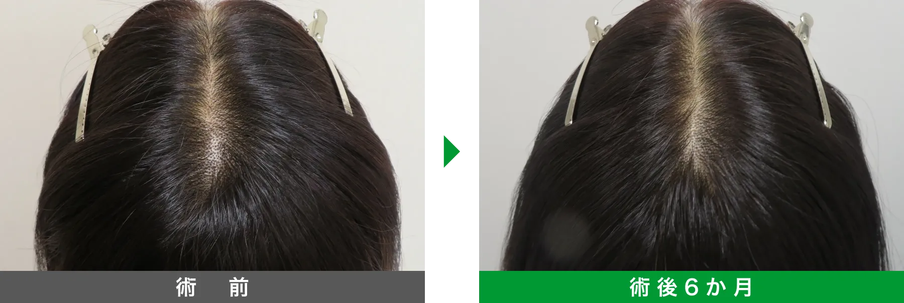 w-スカルプ 症例写真 術後 6か月