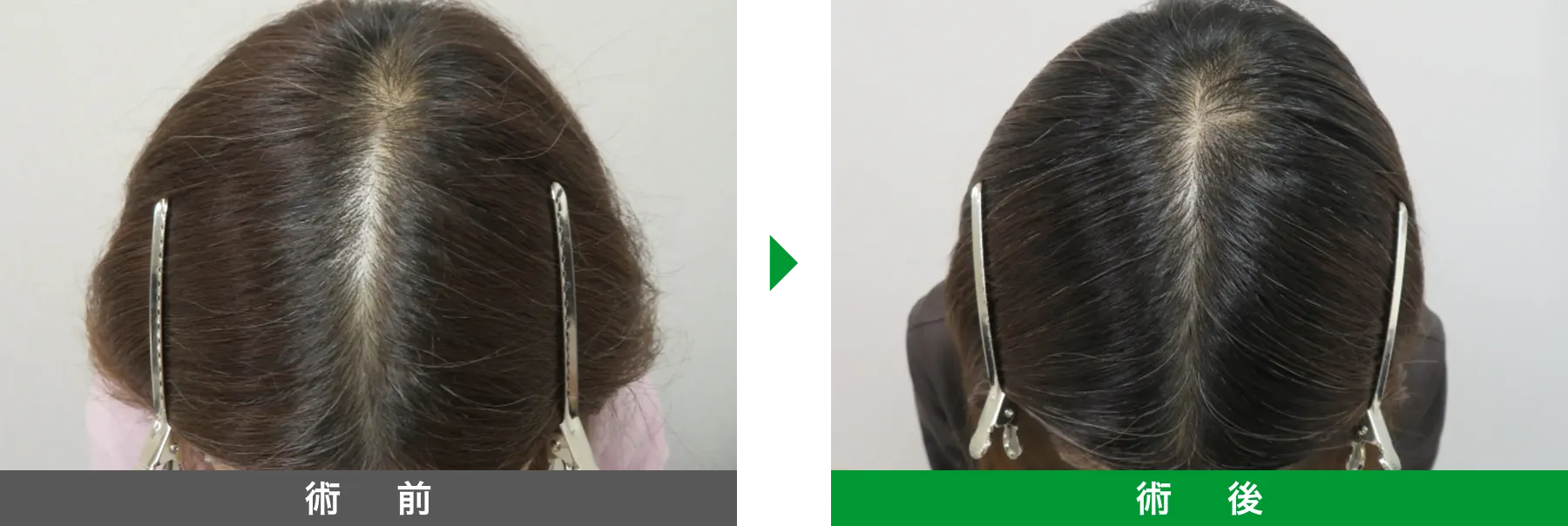 w-スカルプ 症例写真 術後