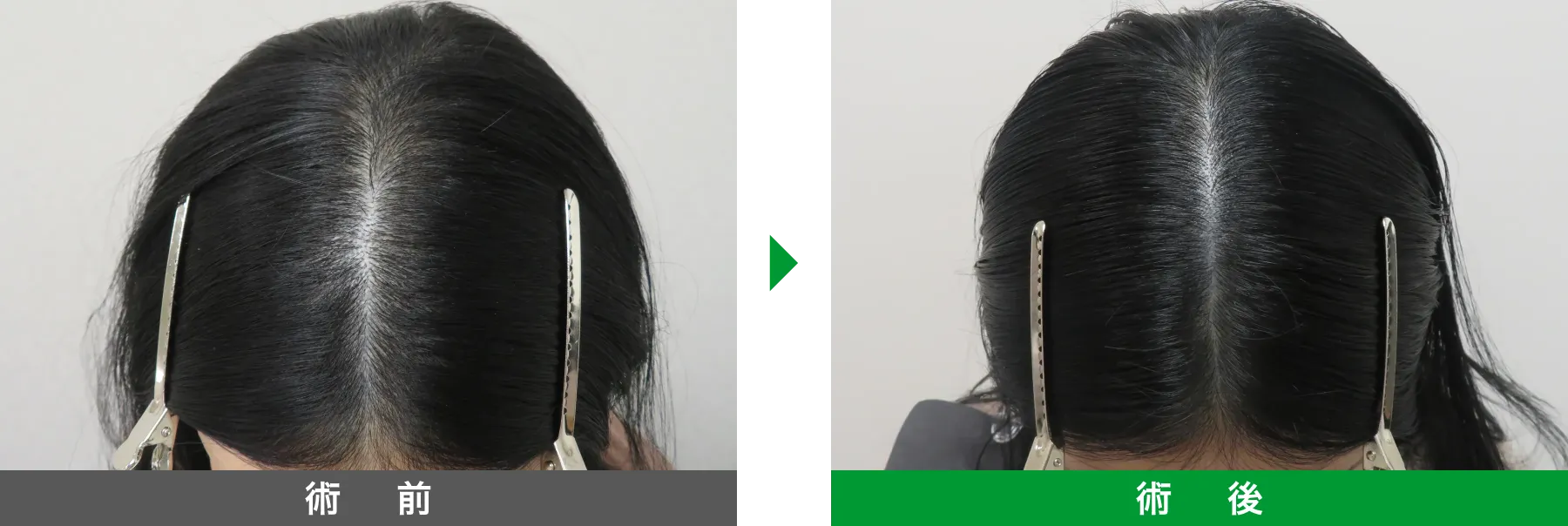 w-スカルプ 症例写真 術後