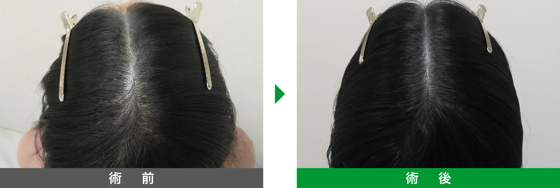 w-スカルプ 症例写真 術後