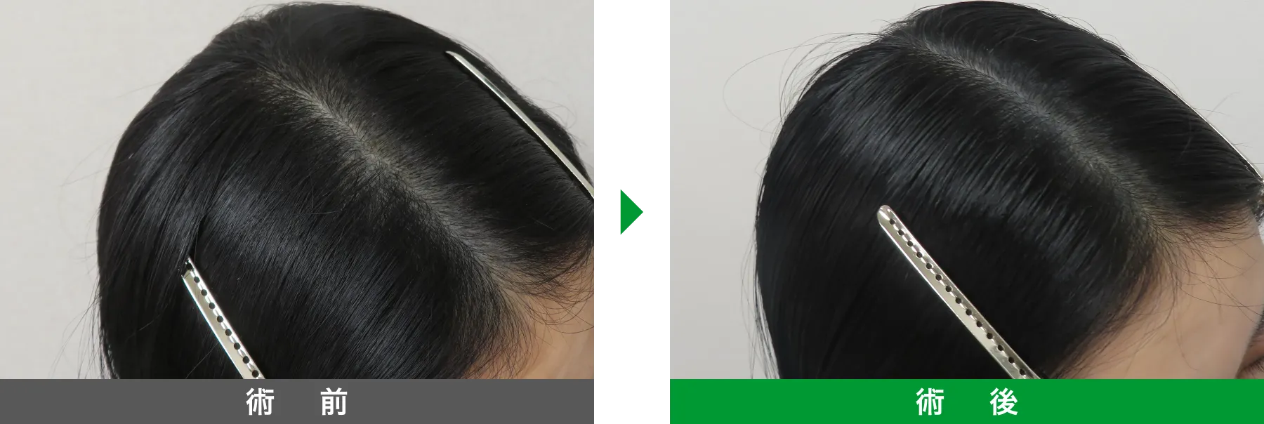 w-スカルプ 症例写真 術後