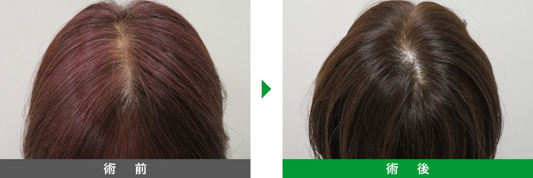 w-スカルプ 症例写真 術後