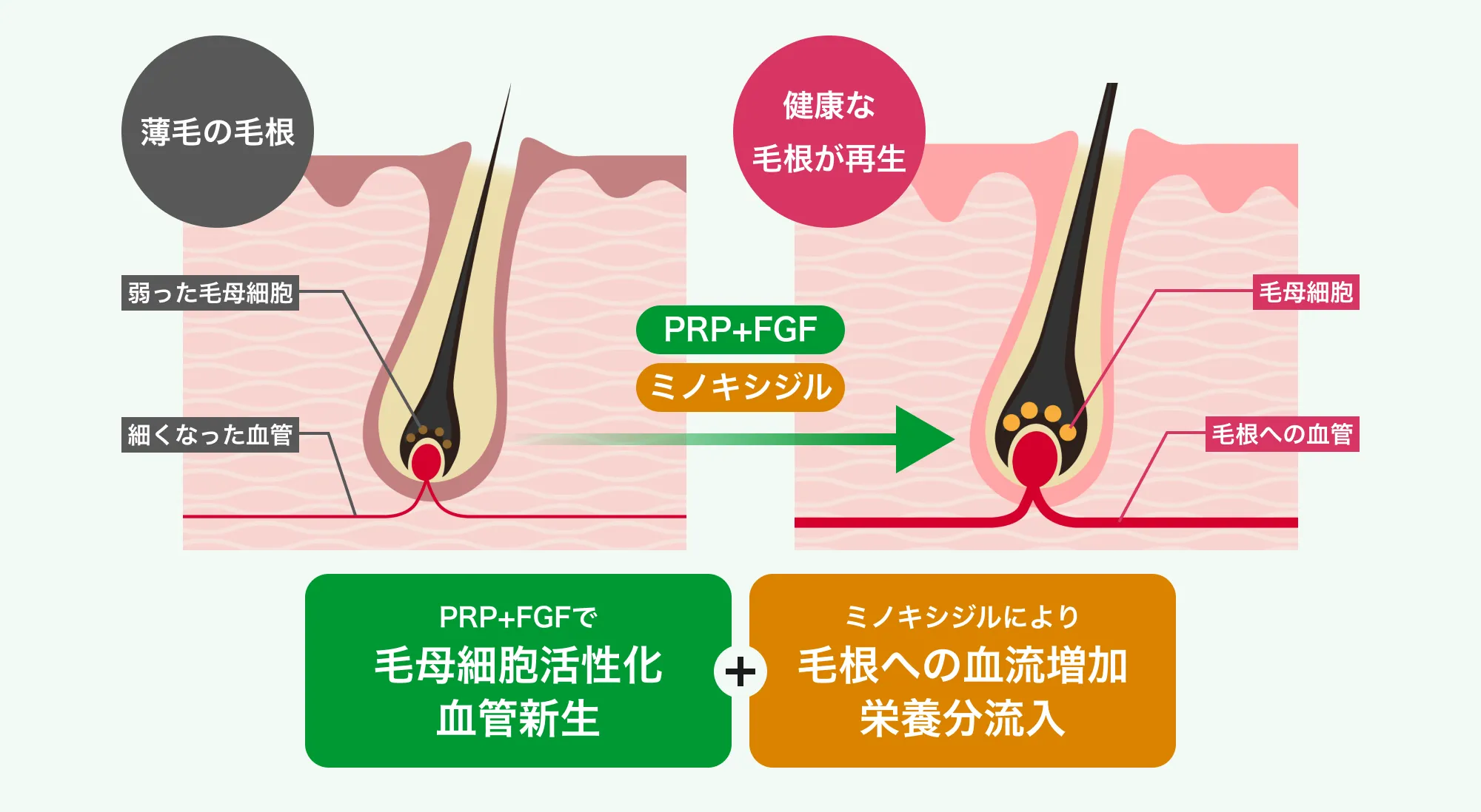 薄毛の毛根健康な毛根が再生