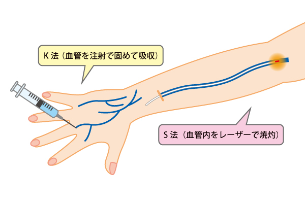 KS法