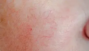顔の硬化療法
