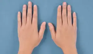 ハンドベインの症例写真