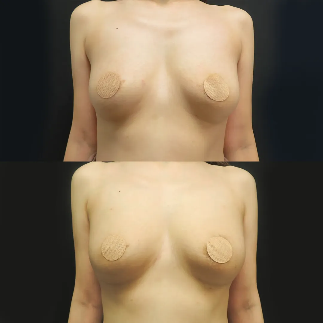 PRP注射（お胸）