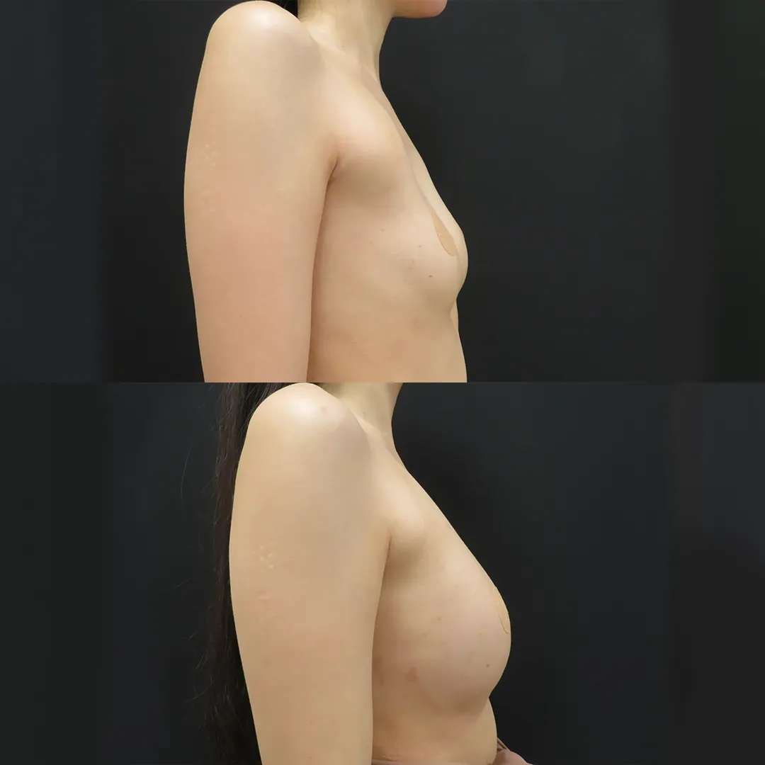 PRP注射プレミアム（お胸）