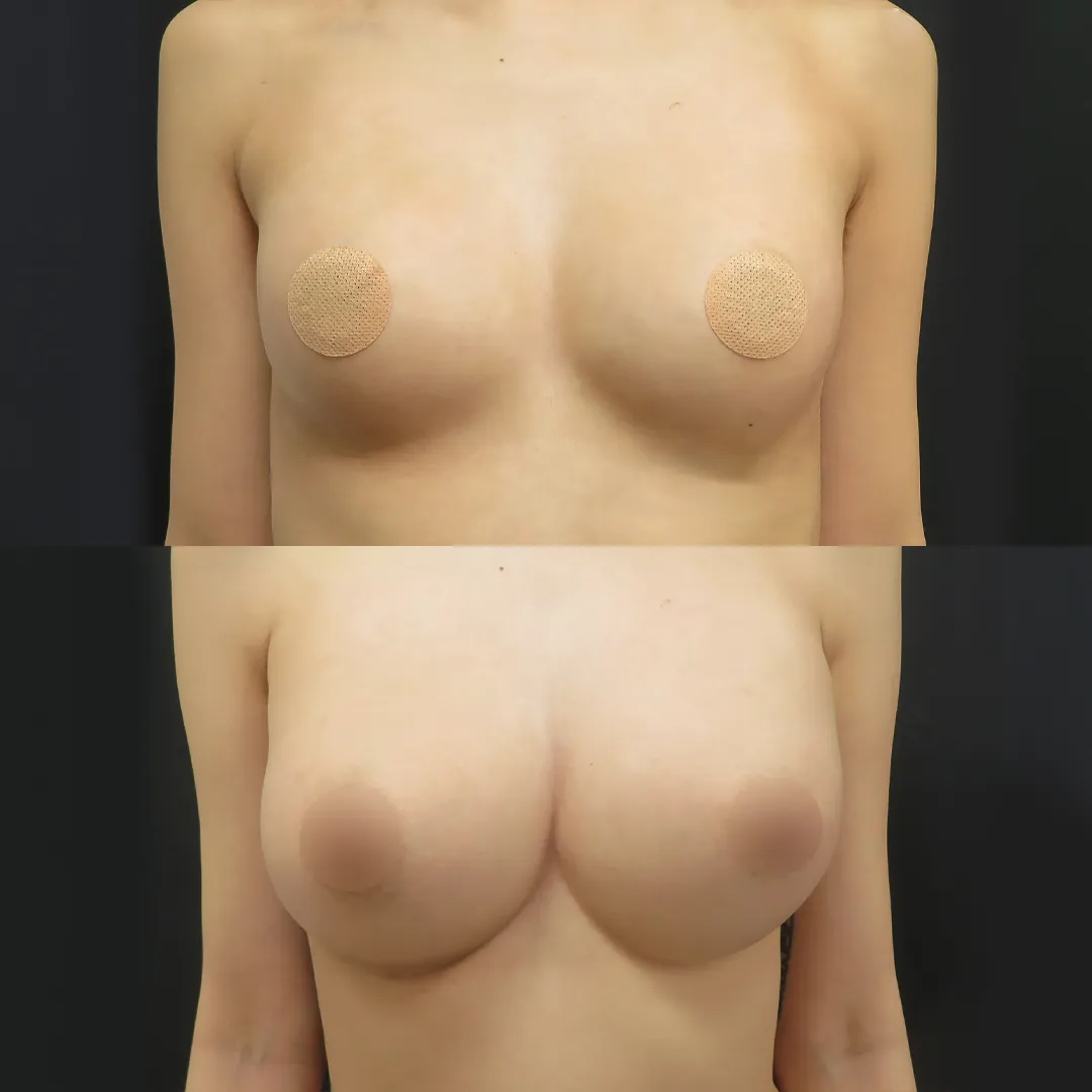 PRP注射（お胸）