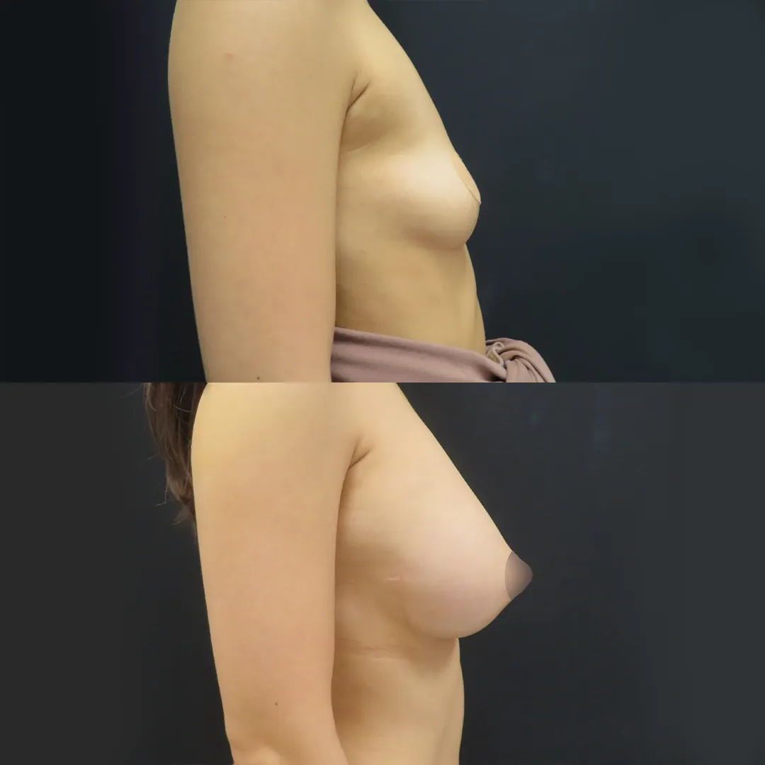 PRP注射プレミアム（お胸）