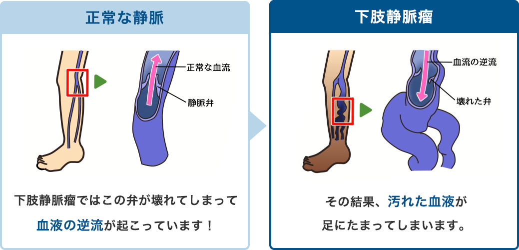 正常な静脈 下肢静脈瘤