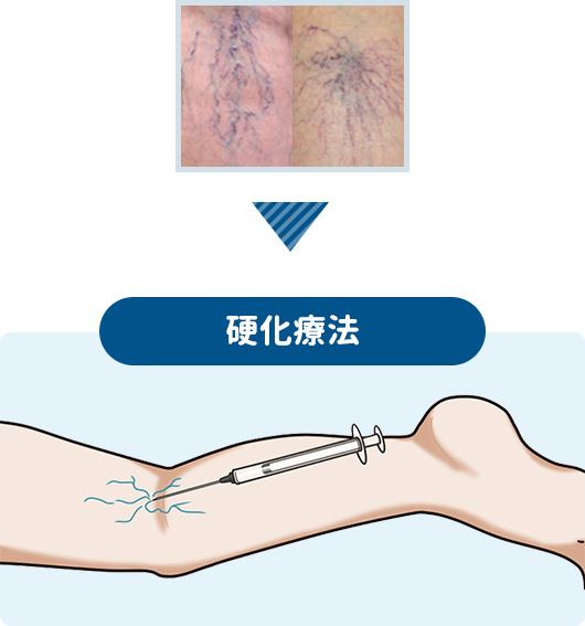 硬化療法