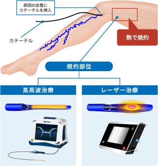 高周波治療とレーザー治療