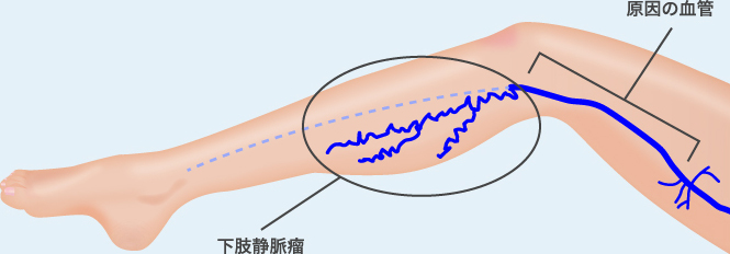 原因の血管の静脈を治療する