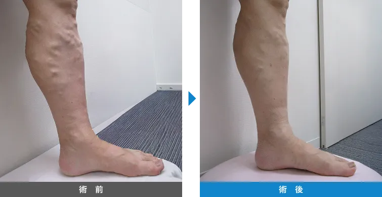 下肢静脈瘤の症例写真